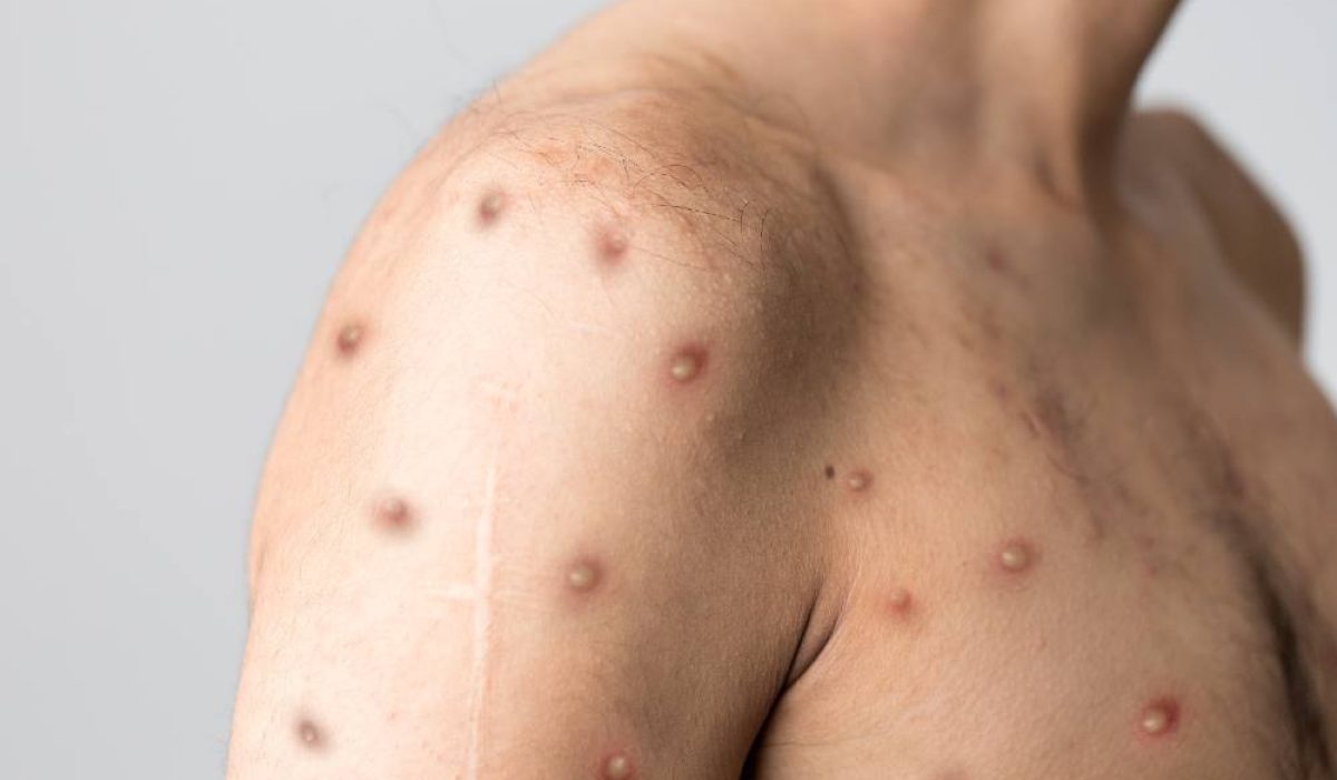 ShoulderWithMonkeypox